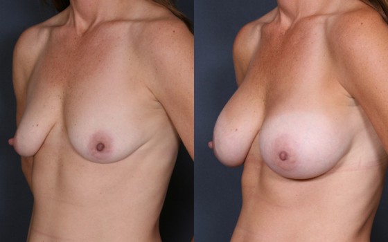 HMR-Breast-Augmentation2-2