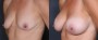 Dr. Roark Breast Augmentation Patient 2