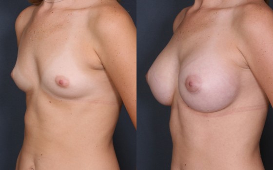 HMR-Breast-Augmentation3-2
