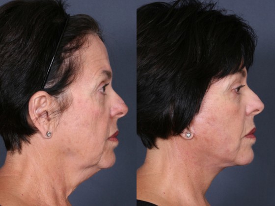 Dr. Roark Neck Lift Patient 1