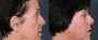 Dr. Roark Facelift Patient 2