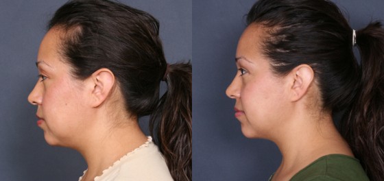 Dr. Roark Neck Liposuction Patient 1
