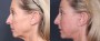 Dr. Roark Eyelid Lift Patient 1