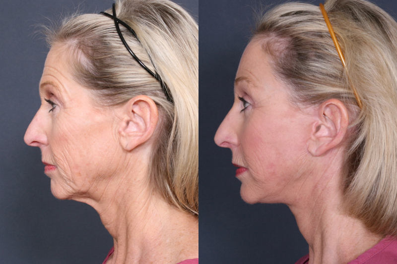 Before & after example