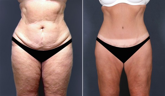 Dr. Saltz Tummy Tuck Patient 1