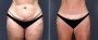 Dr. Saltz Tummy Tuck Patient 1