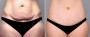 Dr. Saltz Tummy Tuck Patient 2