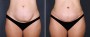 Dr. Saltz Tummy Tuck Patient 3