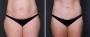 Dr. Saltz Tummy Tuck Patient 4