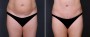 Dr. Saltz Tummy Tuck Patient 5
