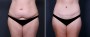 Dr. Saltz Tummy Tuck Patient 6