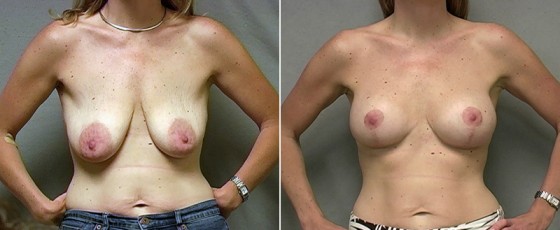 Dr. Saltz Breast Lift Patient 1