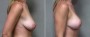 Dr. Saltz Breast Lift Patient 2