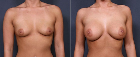Dr. Saltz Breast Augmentation Patient 1