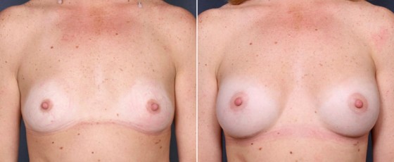 dr-saltz-breast-augmentation-38a