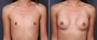 Dr. Saltz Breast Augmentation Patient 18