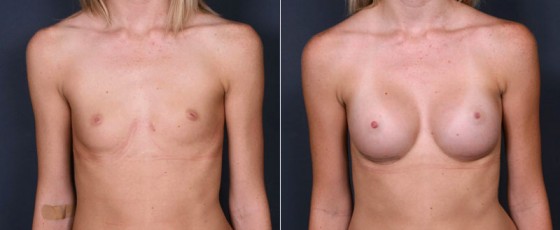 dr-saltz-breast-augmentation-52a
