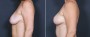 Dr. Saltz Breast Lift Patient 4