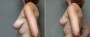 Dr. Saltz Breast Lift Patient 6