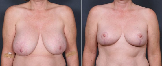 dr-saltz-breast-reduction-08a
