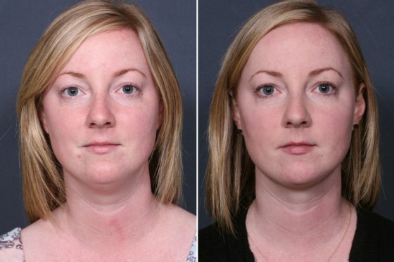 Dr. Brahme Neck Liposuction Patient 1